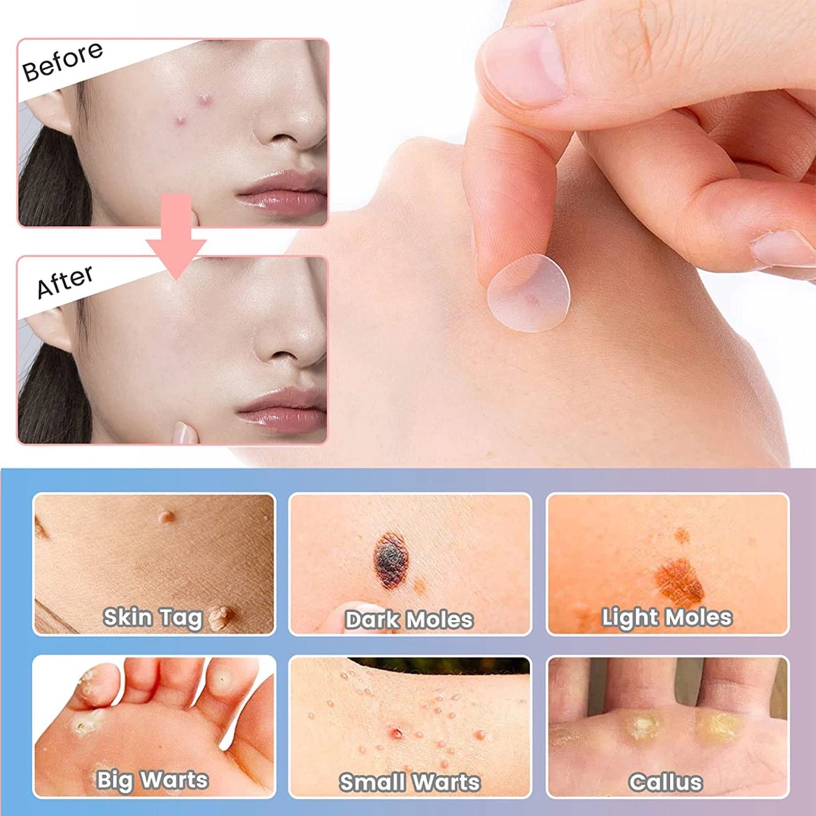  Invisible Removal Pimple Anti-Acne Hydrocolloid Patches Spots Marks Concealer Waterproof Repair Sticker