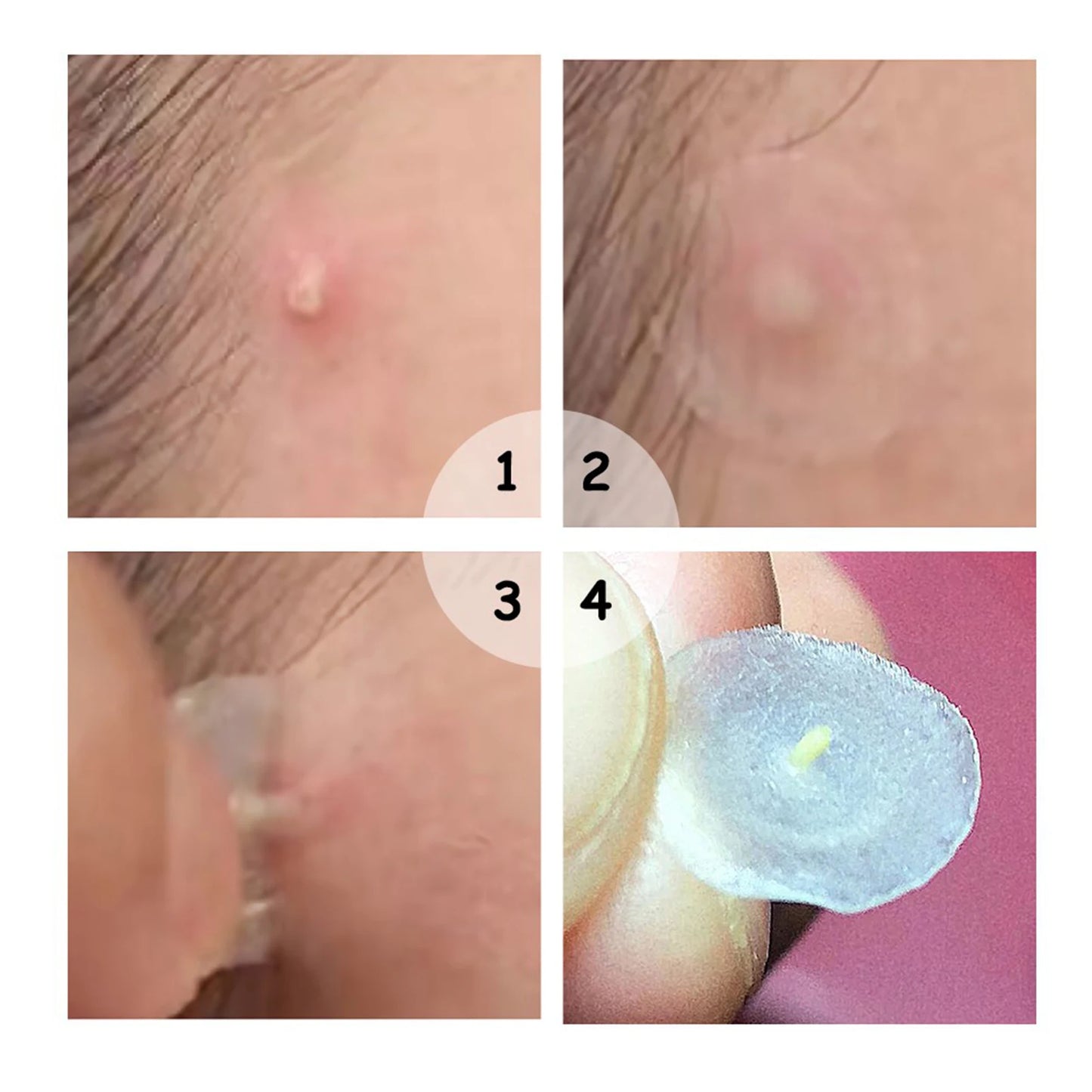  Invisible Removal Pimple Anti-Acne Hydrocolloid Patches Spots Marks Concealer Waterproof Repair Sticker
